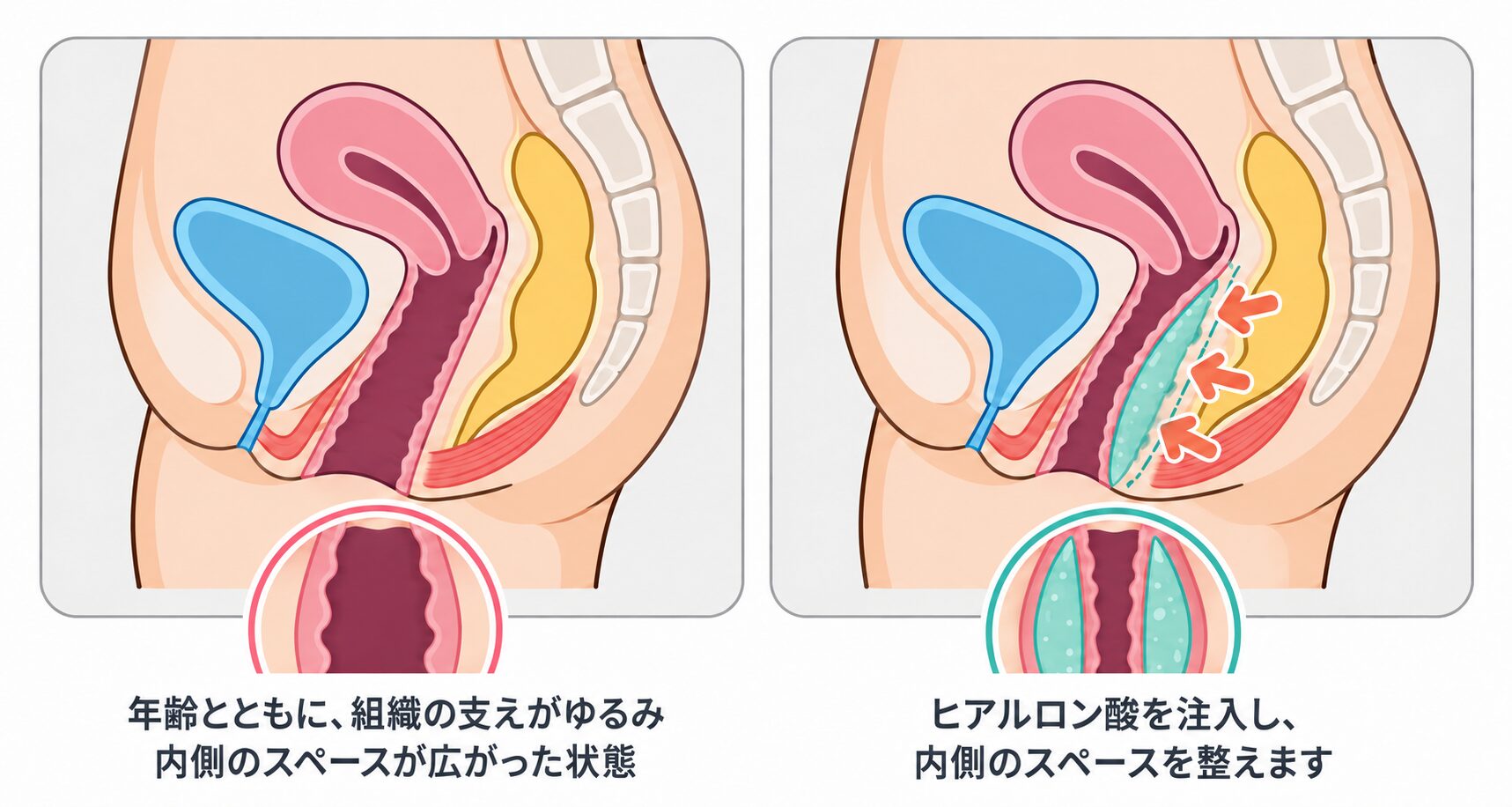 膣ヒアルロン酸注射の仕組みを示すイメージ